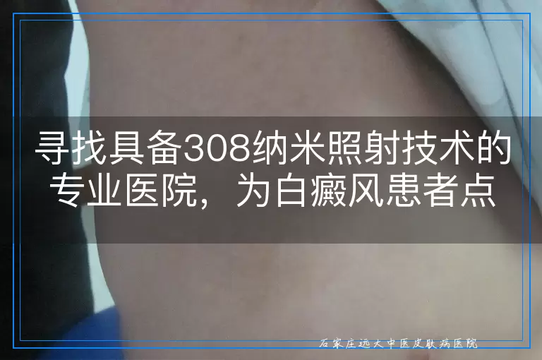 寻找具备308纳米照射技术的专业医院，为白癜风患者点亮希望之光