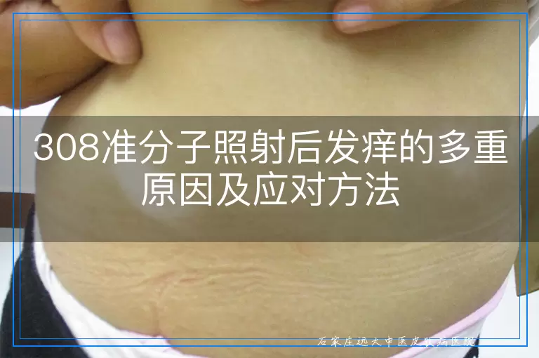 308准分子照射后发痒的多重原因及应对方法