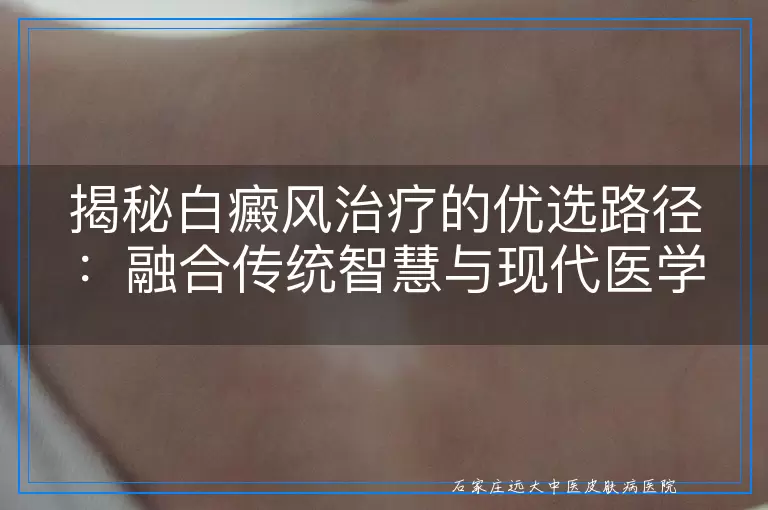 揭秘白癜风治疗的优选路径：融合传统智慧与现代医学的最佳实践