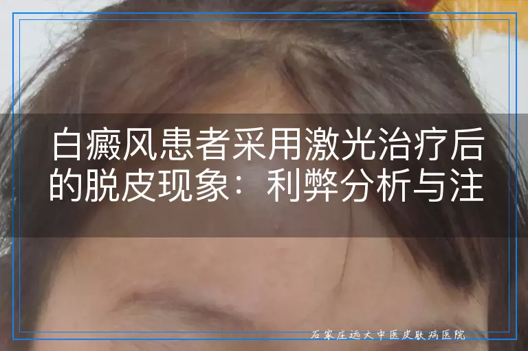 白癜风患者采用激光治疗后的脱皮现象：利弊分析与注意事项
