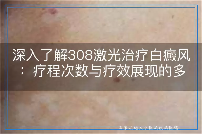 深入了解308激光治疗白癜风：疗程次数与疗效展现的多维度探讨
