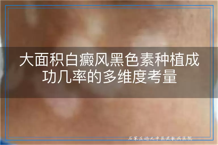 大面积白癜风黑色素种植成功几率的多维度考量