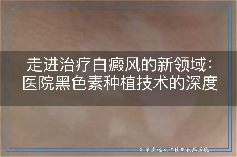 走进治疗白癜风的新领域：医院黑色素种植技术的深度透视与实践案例