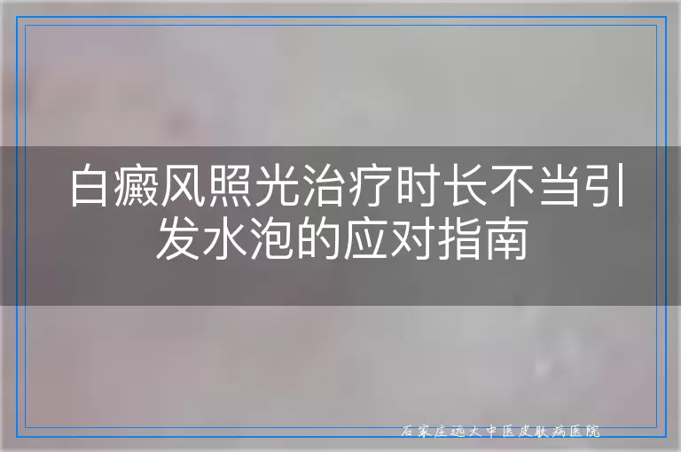 白癜风照光治疗时长不当引发水泡的应对指南