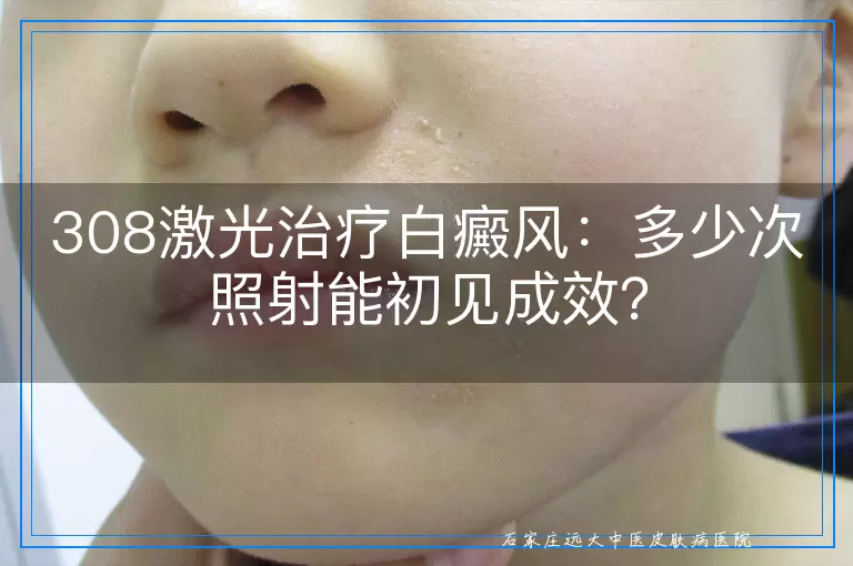308激光治疗白癜风：多少次照射能初见成效？