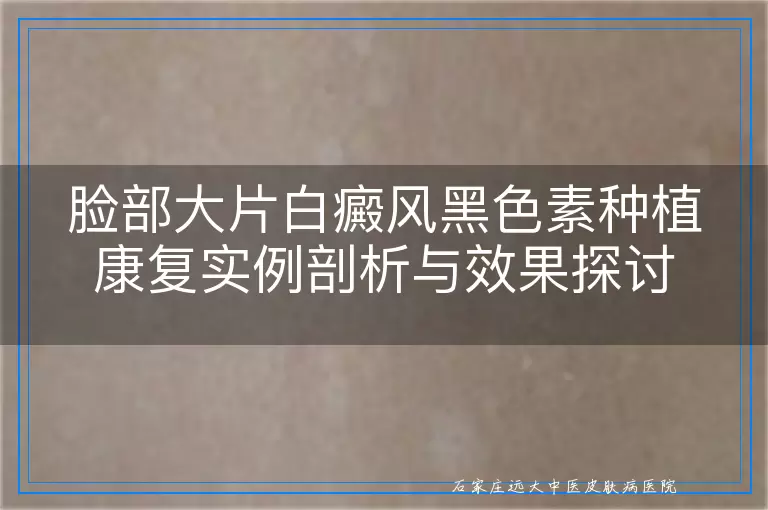 脸部大片白癜风黑色素种植康复实例剖析与效果探讨