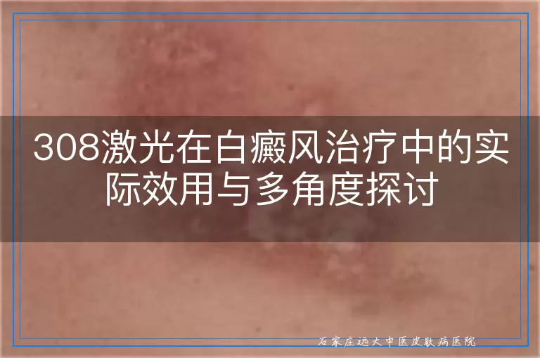 308激光在白癜风治疗中的实际效用与多角度探讨