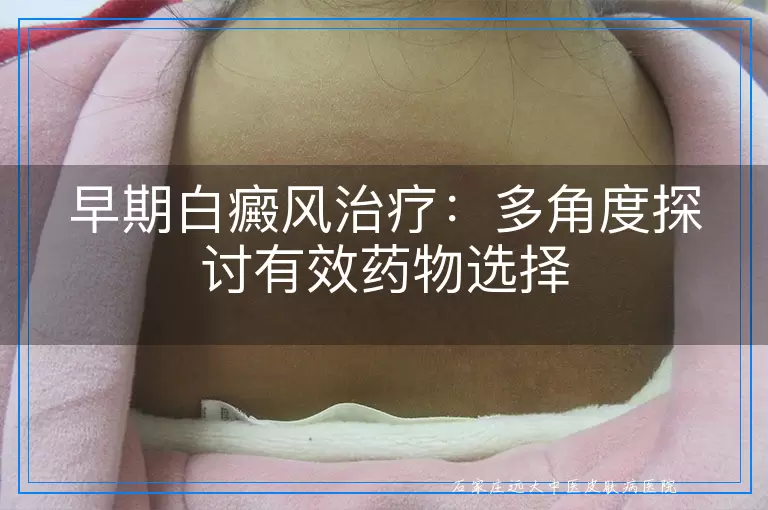 早期白癜风治疗：多角度探讨有效药物选择