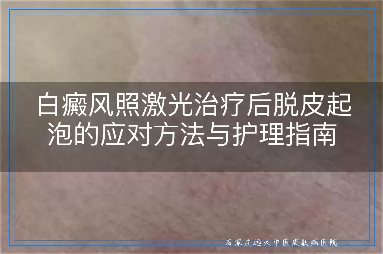 白癜风照激光治疗后脱皮起泡的应对方法与护理指南