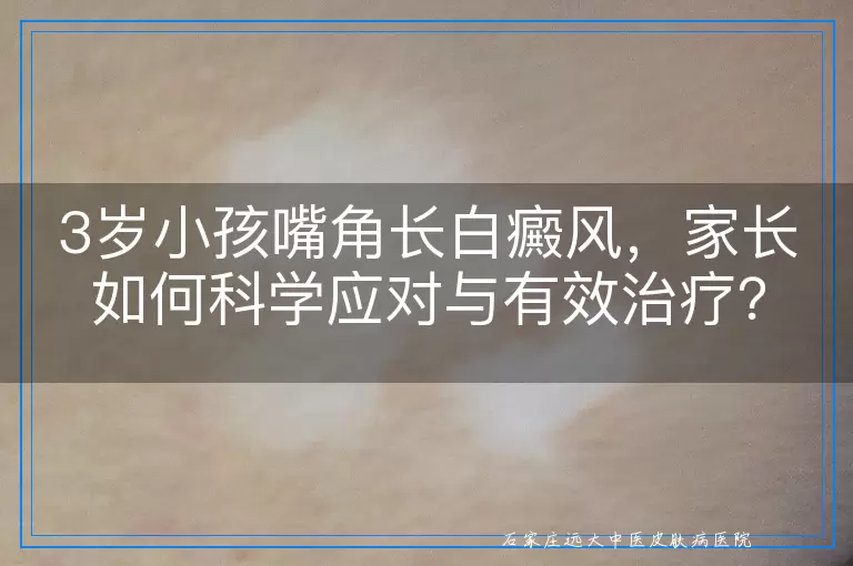 3岁小孩嘴角长白癜风，家长如何科学应对与有效治疗？
