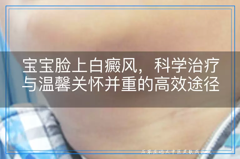 宝宝脸上白癜风，科学治疗与温馨关怀并重的高效途径