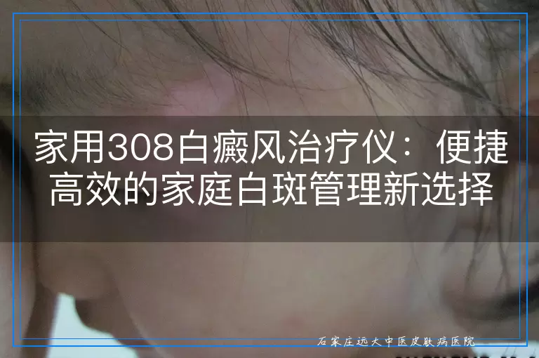 家用308白癜风治疗仪：便捷高效的家庭白斑管理新选择