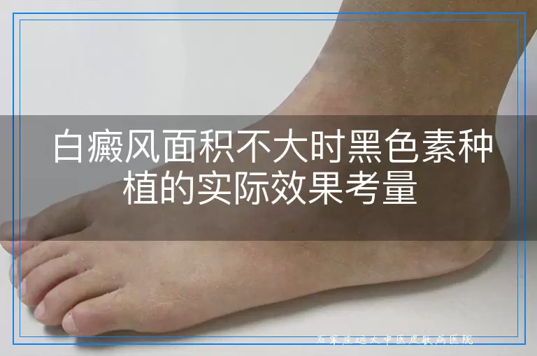 白癜风面积不大时黑色素种植的实际效果考量