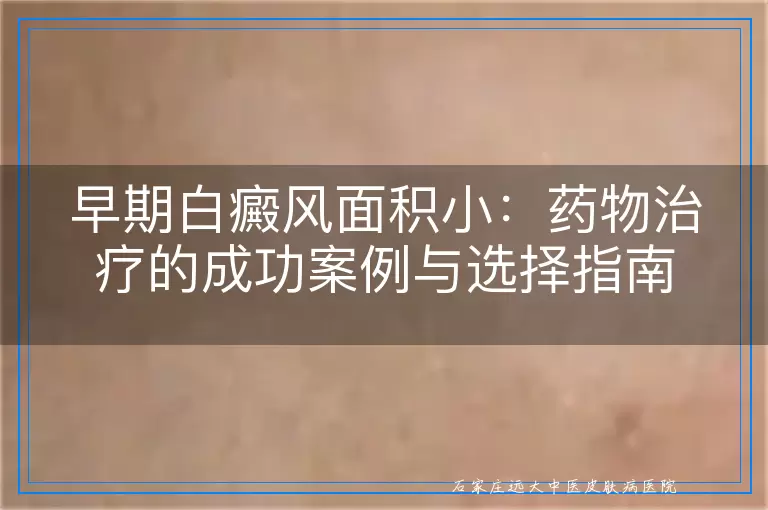 早期白癜风面积小：药物治疗的成功案例与选择指南