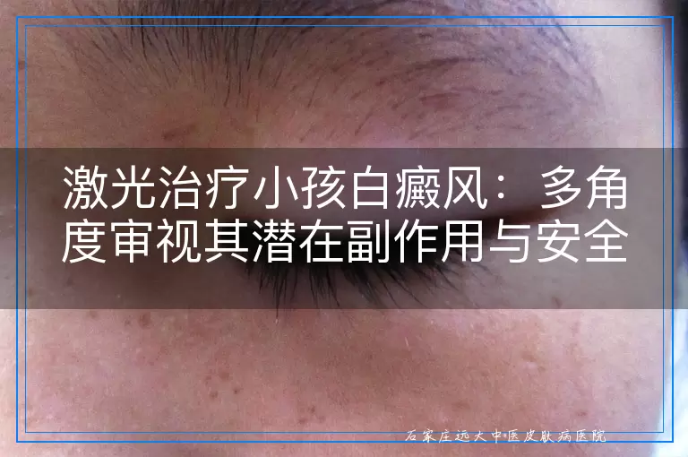 激光治疗小孩白癜风：多角度审视其潜在副作用与安全性