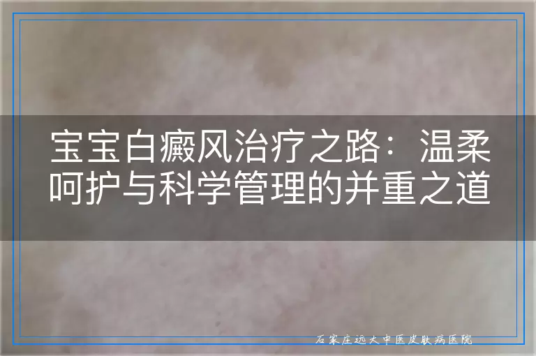 宝宝白癜风治疗之路：温柔呵护与科学管理的并重之道
