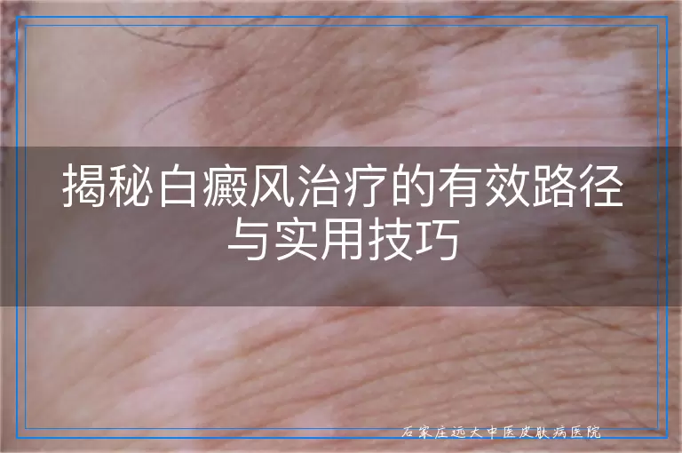揭秘白癜风治疗的有效路径与实用技巧