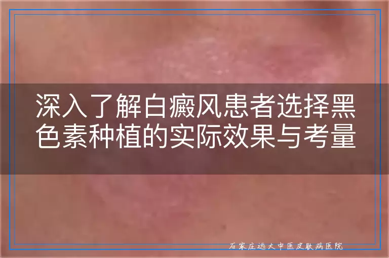 深入了解白癜风患者选择黑色素种植的实际效果与考量
