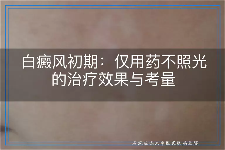 白癜风初期：仅用药不照光的治疗效果与考量