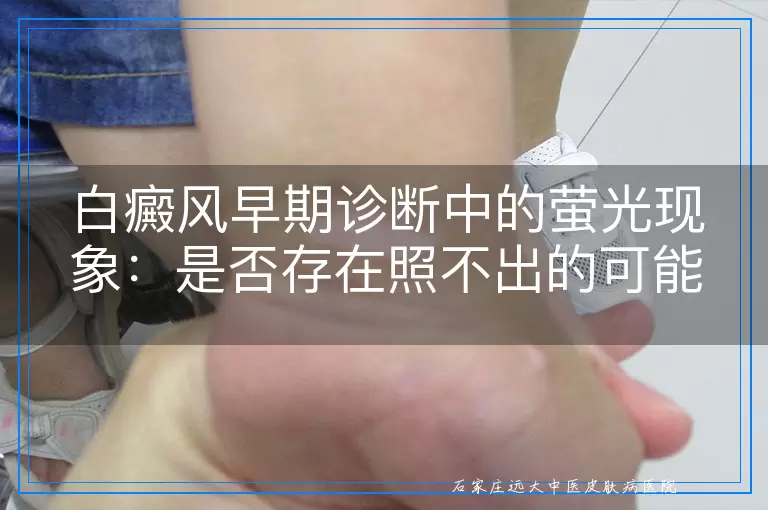 白癜风早期诊断中的萤光现象：是否存在照不出的可能？