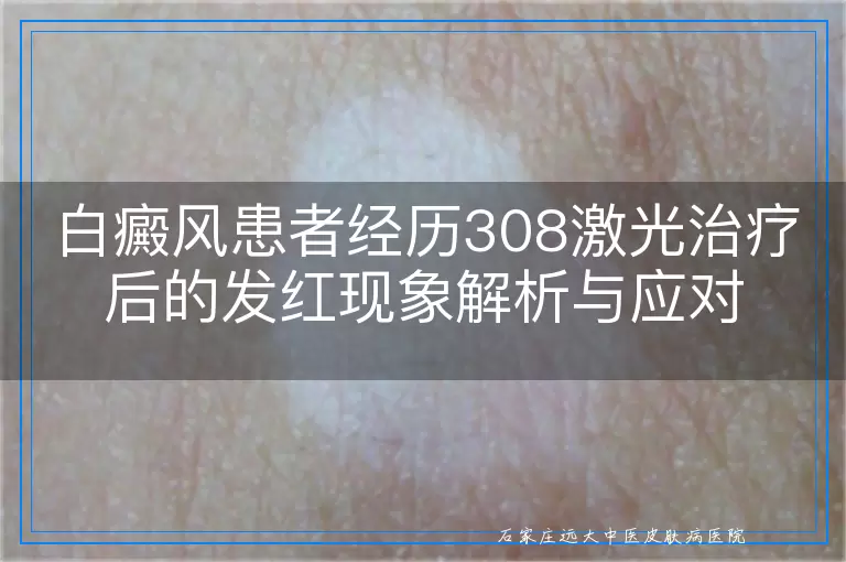 白癜风患者经历308激光治疗后的发红现象解析与应对