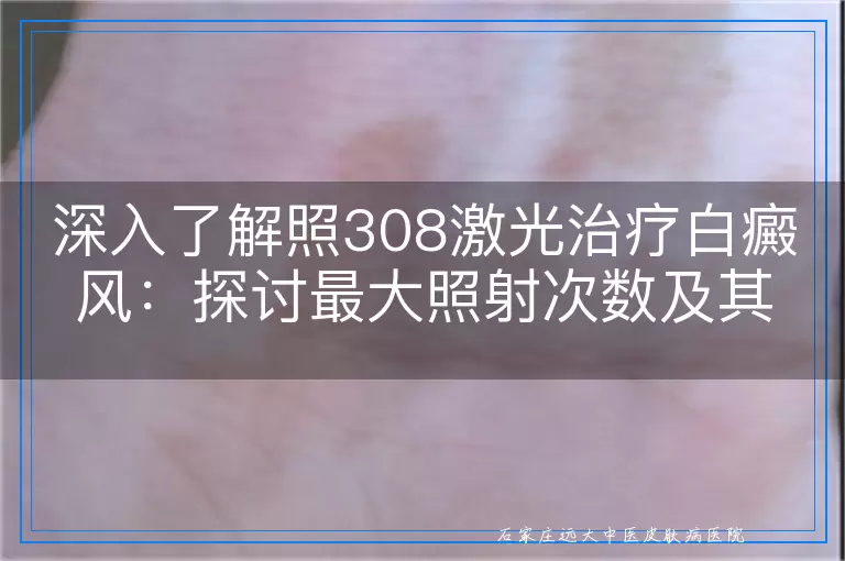 深入了解照308激光治疗白癜风：探讨最大照射次数及其考量因素