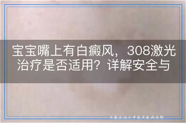 宝宝嘴上有白癜风，308激光治疗是否适用？详解安全与治疗考量