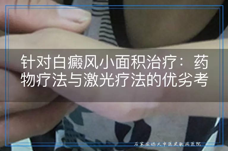针对白癜风小面积治疗：药物疗法与激光疗法的优劣考量