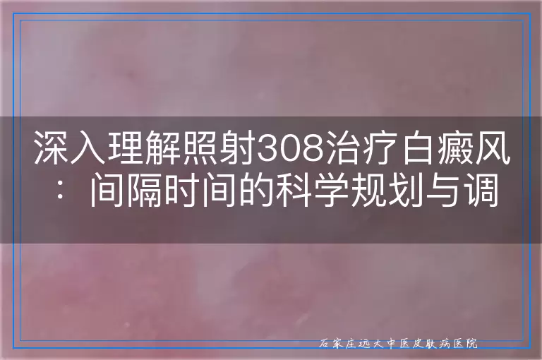 深入理解照射308治疗白癜风：间隔时间的科学规划与调整
