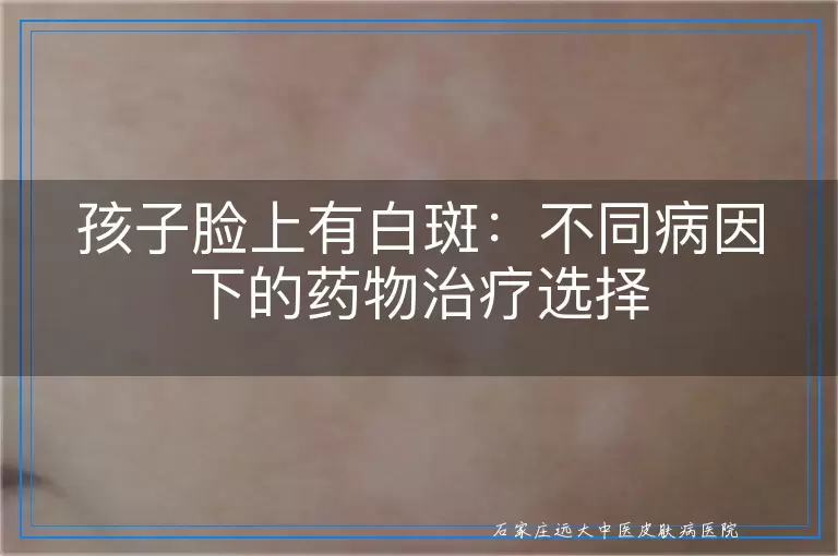 孩子脸上有白斑：不同病因下的药物治疗选择