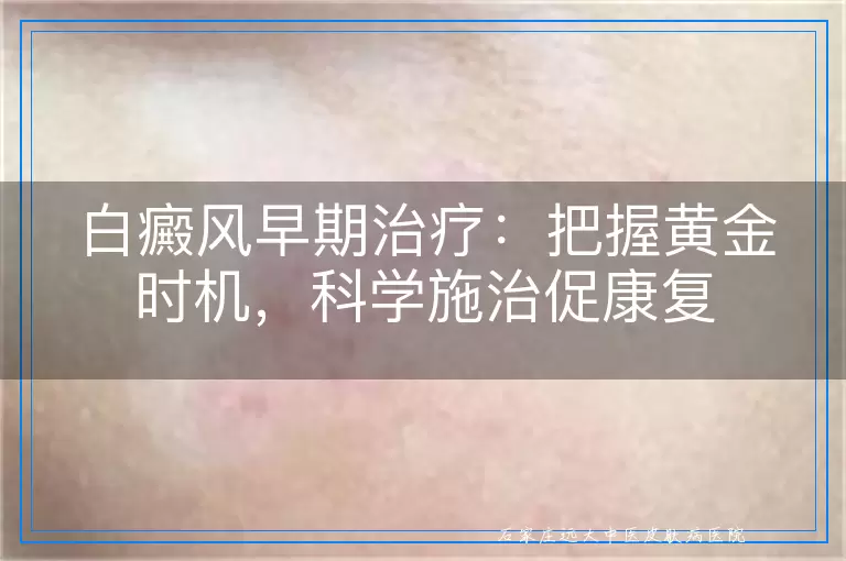 白癜风早期治疗：把握黄金时机，科学施治促康复