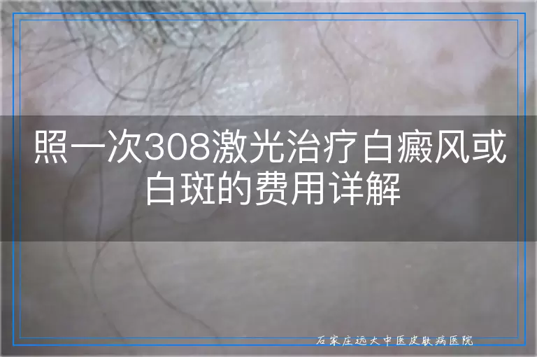 照一次308激光治疗白癜风或白斑的费用详解