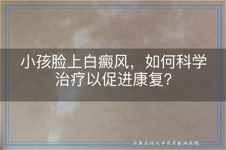 小孩脸上白癜风，如何科学治疗以促进康复？