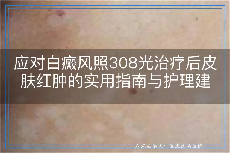应对白癜风照308光治疗后皮肤红肿的实用指南与护理建议