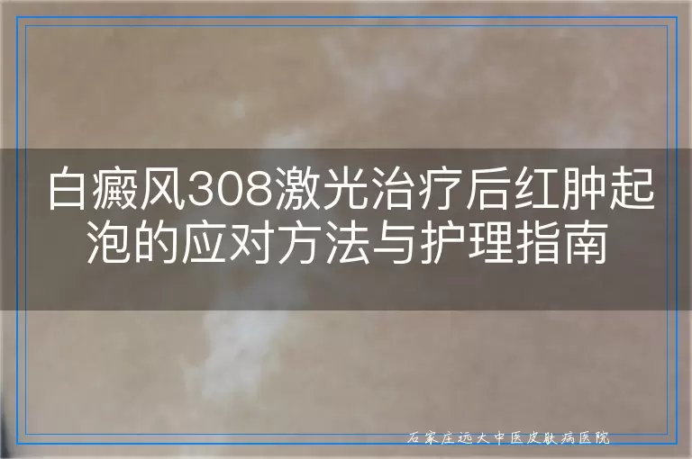 白癜风308激光治疗后红肿起泡的应对方法与护理指南