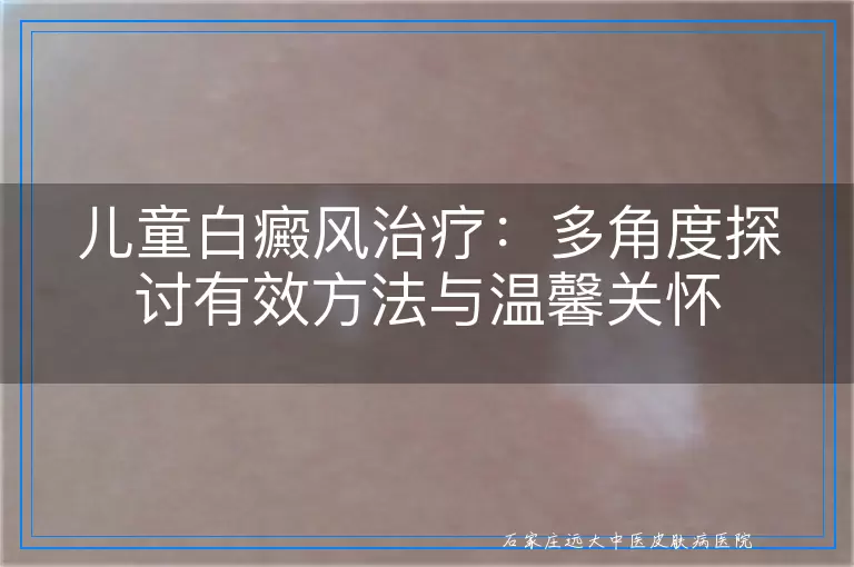 儿童白癜风治疗：多角度探讨有效方法与温馨关怀