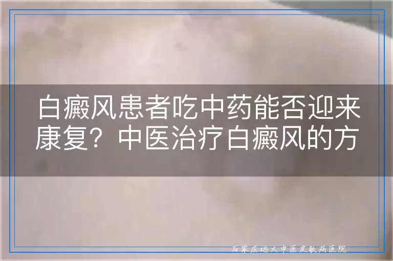 白癜风患者吃中药能否迎来康复？中医治疗白癜风的方法与效果探讨