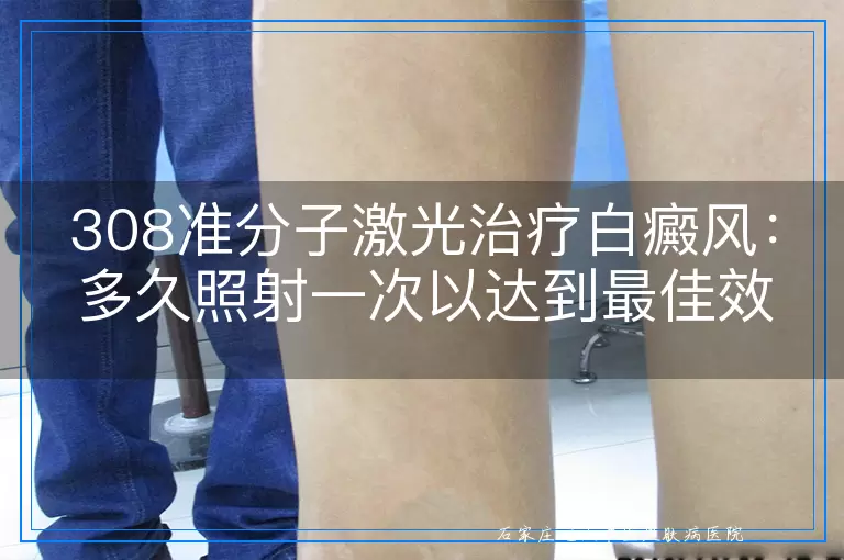 308准分子激光治疗白癜风：多久照射一次以达到最佳效果？
