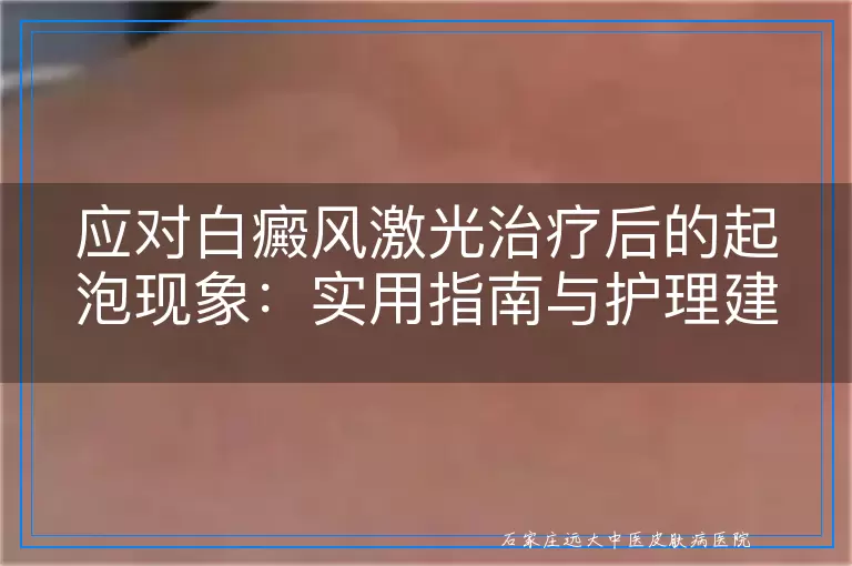 应对白癜风激光治疗后的起泡现象：实用指南与护理建议