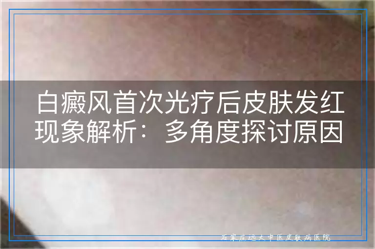 白癜风首次光疗后皮肤发红现象解析：多角度探讨原因与应对措施