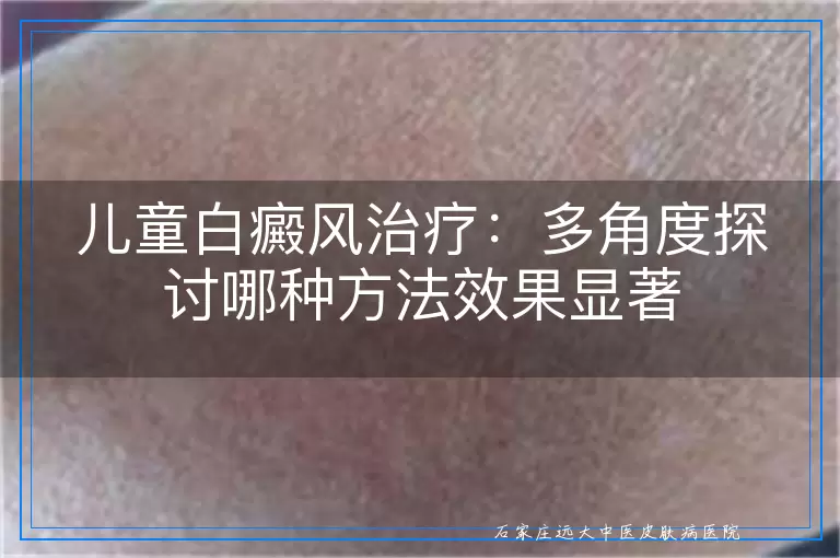 儿童白癜风治疗：多角度探讨哪种方法效果显著