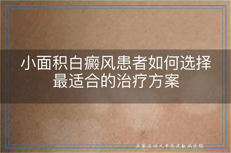 小面积白癜风患者如何选择最适合的治疗方案
