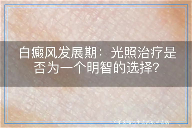 白癜风发展期：光照治疗是否为一个明智的选择？