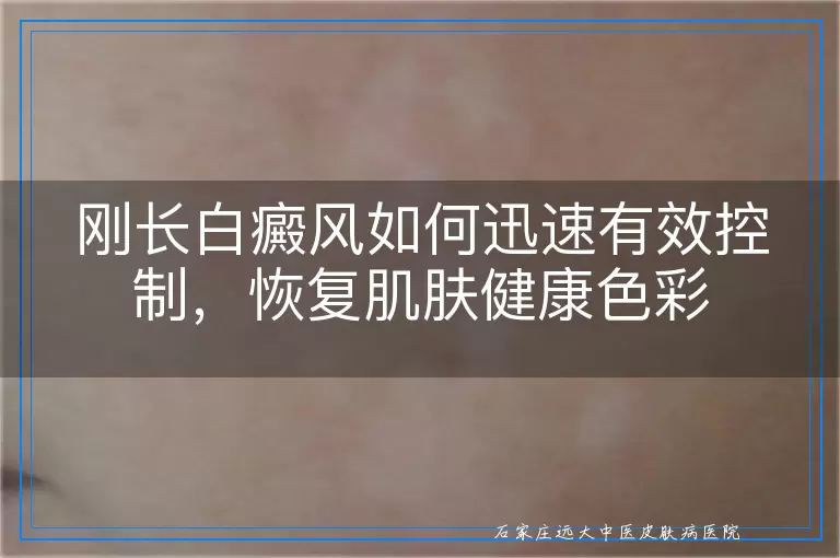 刚长白癜风如何迅速有效控制，恢复肌肤健康色彩