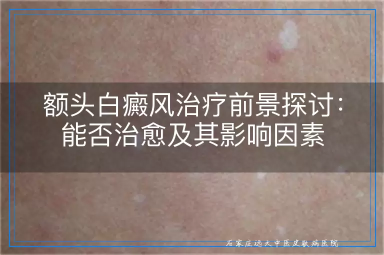 额头白癜风治疗前景探讨：能否治愈及其影响因素