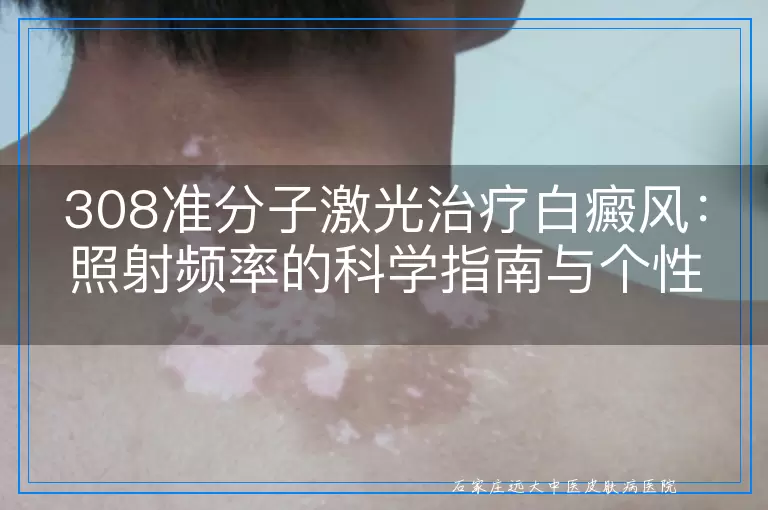 308准分子激光治疗白癜风：照射频率的科学指南与个性化调整