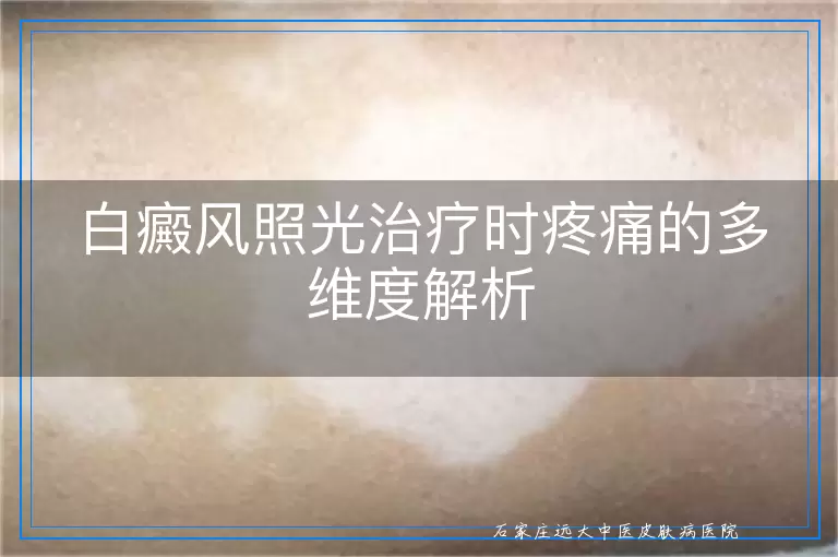 白癜风照光治疗时疼痛的多维度解析
