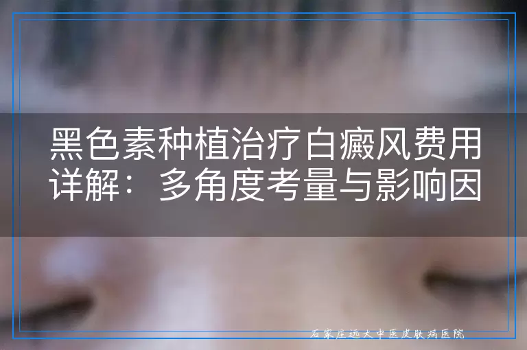 黑色素种植治疗白癜风费用详解：多角度考量与影响因素