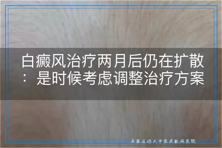 白癜风治疗两月后仍在扩散：是时候考虑调整治疗方案了吗？