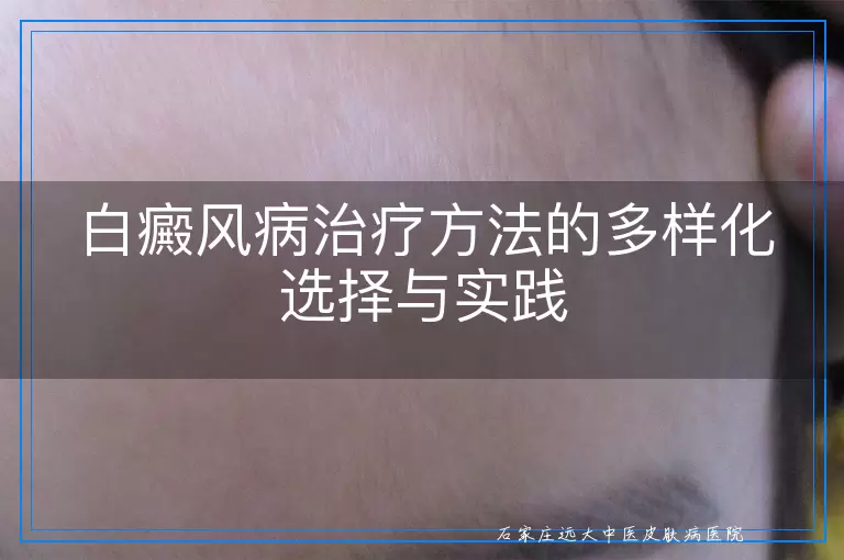 白癜风病治疗方法的多样化选择与实践